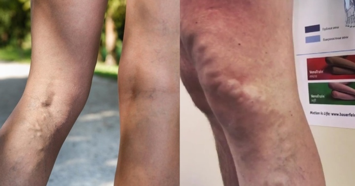 durere în genunchi când flexeaza varicoza bandaje pentru picioare din varicoza